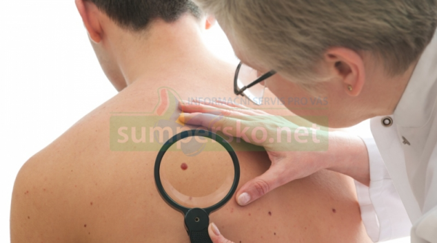 „Spolu proti melanomu“