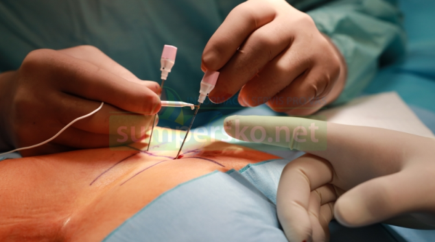 Potíže se střevní inkontinentací může vyřešit neurostimulace