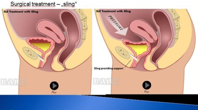 Problémy s únikem moči trápí přes padesát procent žen