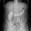 Skutečné RTG snímky, které jsou anonymizované a byly poskytnuty z Kliniky dětské chirurgie FN Brno  zdroj: coi