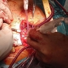 Bezstehová aortální bioprotéza    zdroj foto: FNOL