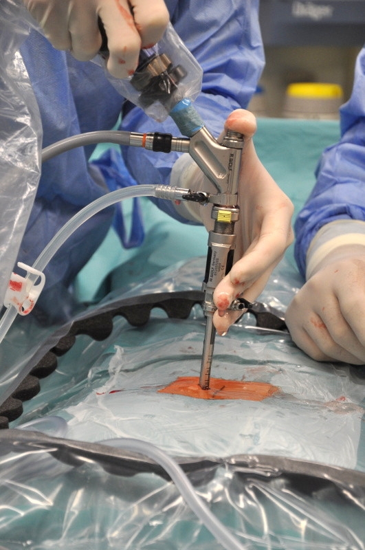 Zavedený endoskop během operace zdroj foto: FNOL